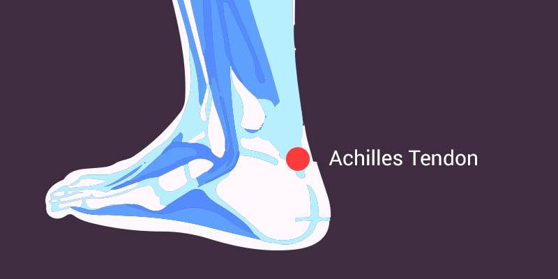 Achilles Pain