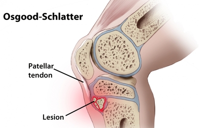 Osgood-Schlatter's disease