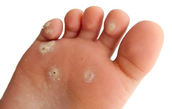 Hpv that causes warts on feet. Hpv foot wart treatment Hpv virus and warts on feet