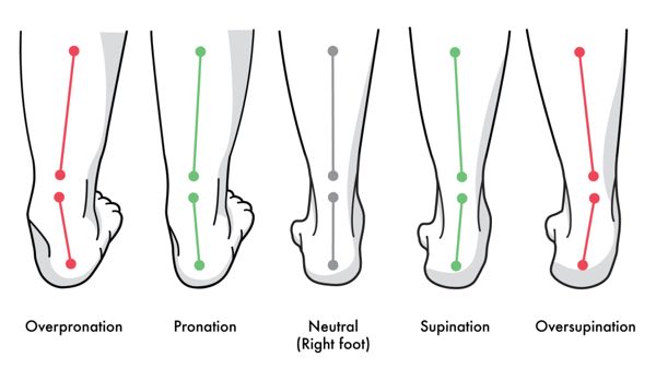 pronated feet